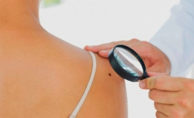 Identificar el cáncer de piel tipo melanoma, a través de la técnica del “ABCDE”